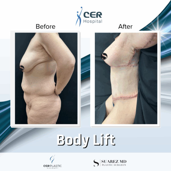 Body Lift - 165 - Image 6