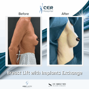 Breast Lift with Implants Exchange – 214