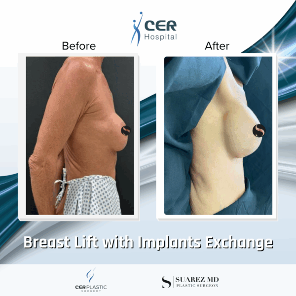 Breast Lift with Implants Exchange - 214