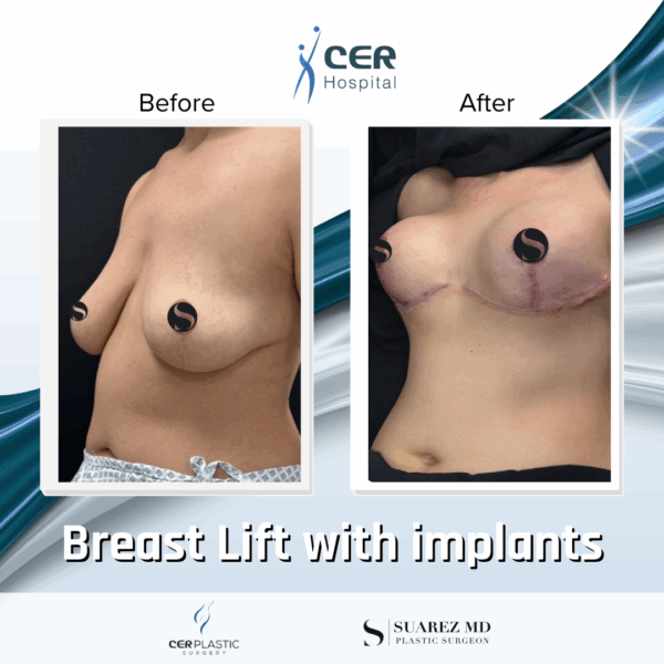 Breast Lift with Implants - 263 - Image 5