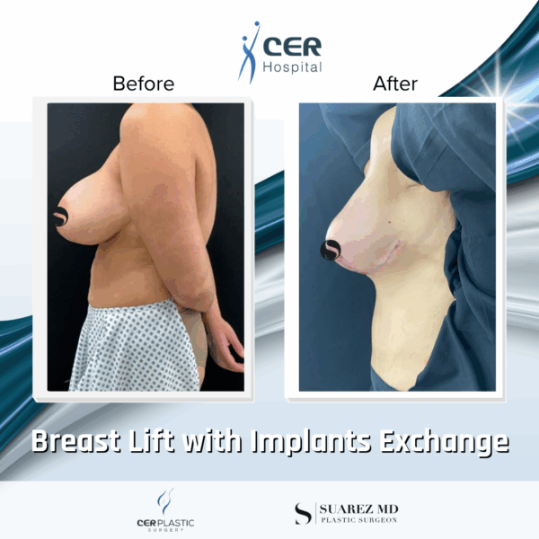 Breast Lift with Implants Exchange - 101 - Image 5