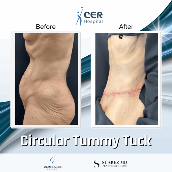 Circular Tummy Tuck - 056 - Image 6