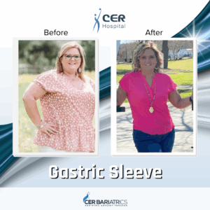 Gastric Sleeve