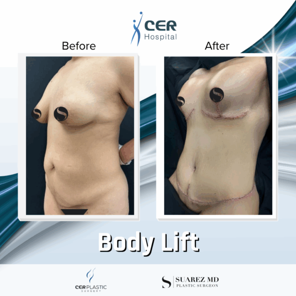 Body Lift - 213 - Image 5