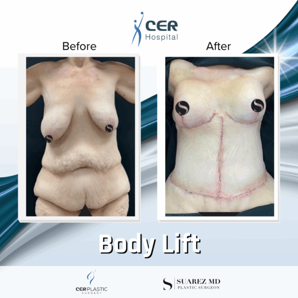 Body Lift - 075 - Image 6