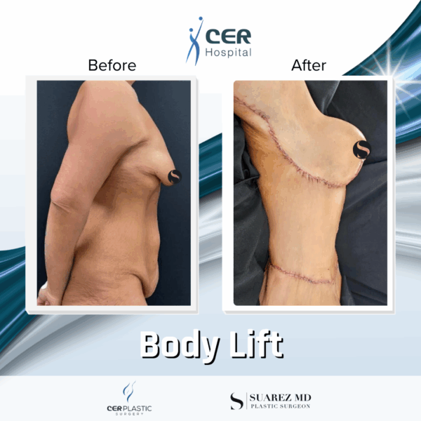 Body Lift - 304 - Image 5
