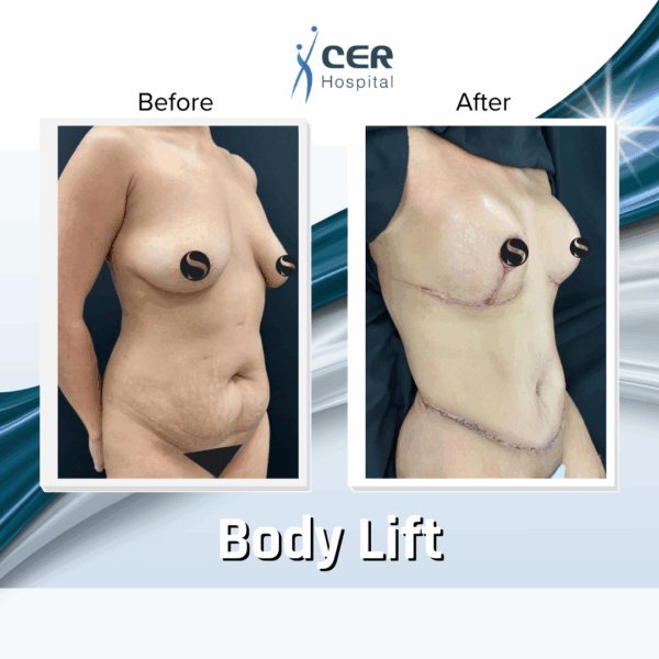 Body Lift - 234 - Image 6