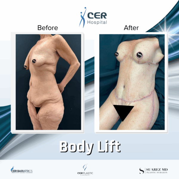 Body Lift - 291 - Image 6