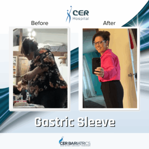 Gastric Sleeve
