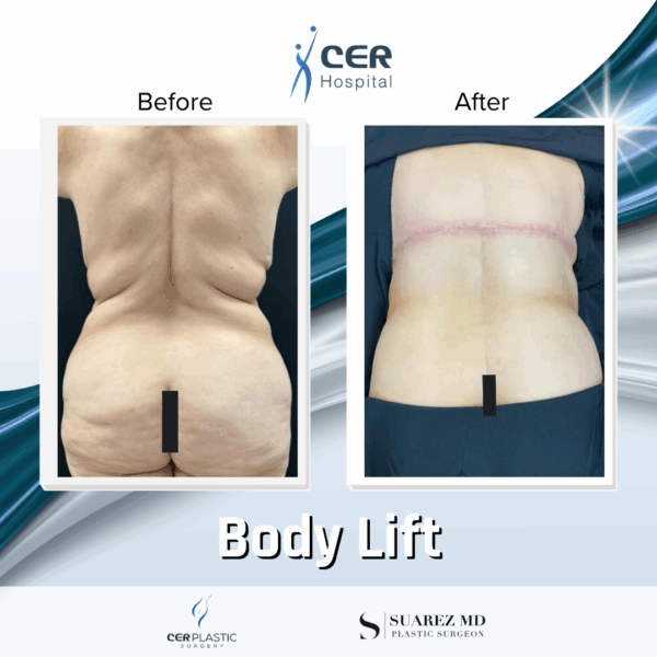 Body Lift - 144 - Image 6