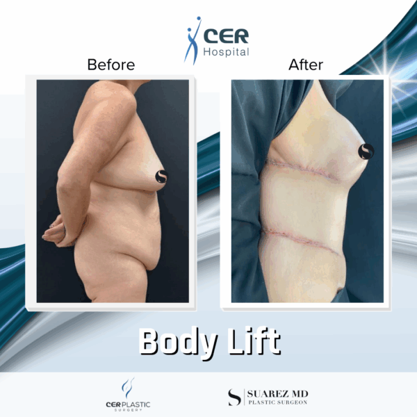 Body Lift - 037 - Image 4