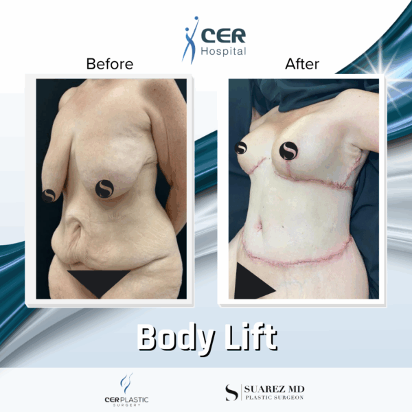 Body Lift -2094 - Image 6