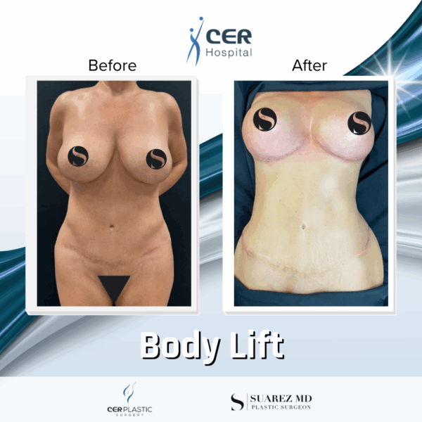 Body Lift -7104 - Image 5