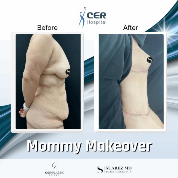 Mommy Makeover - 311 - Image 5
