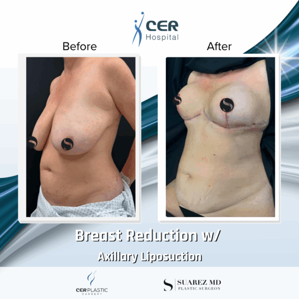 Breast Reduction and Axillary Liposuction - 042 - Image 6