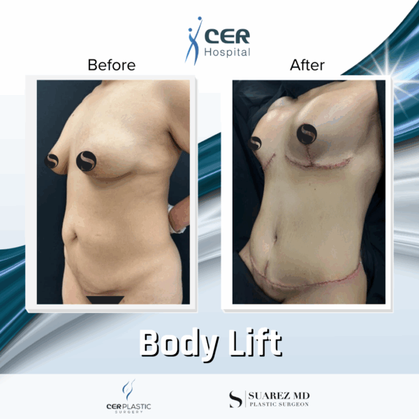 Body Lift - 213 - Image 5