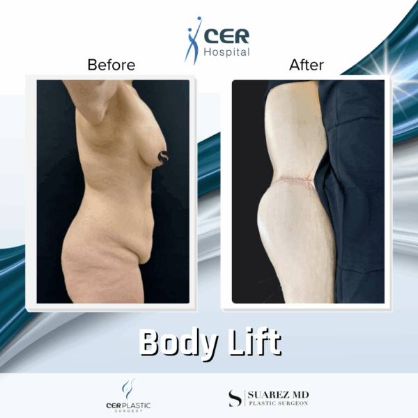 Body Lift - 26064 - Image 6