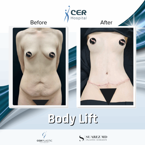 Body Lift - 19064