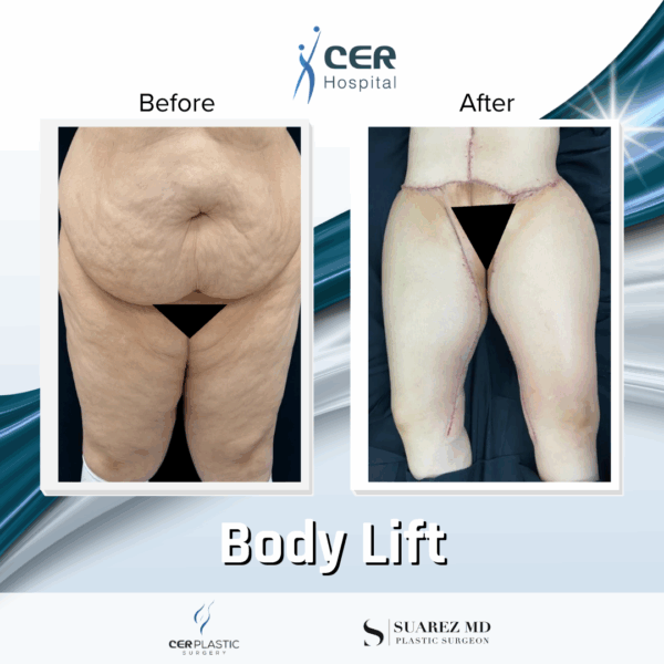 Body Lift - 17064 - Image 5