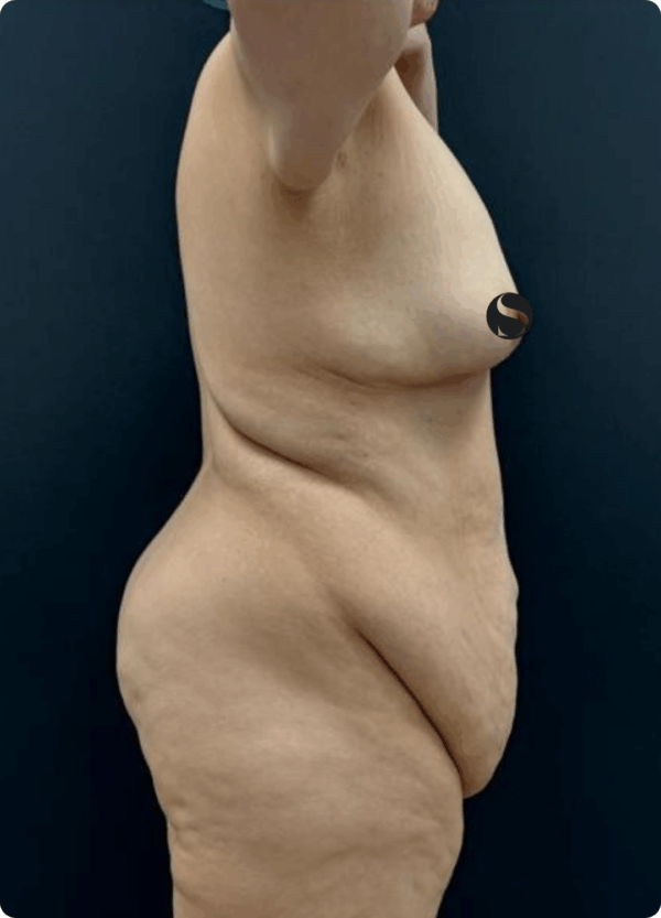 Body Lift - 17064 - Image 3