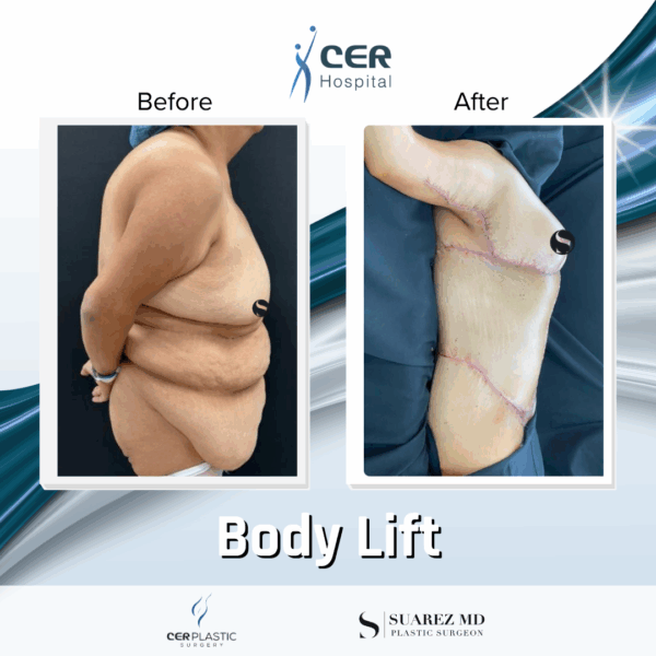 Body Lift -14064
