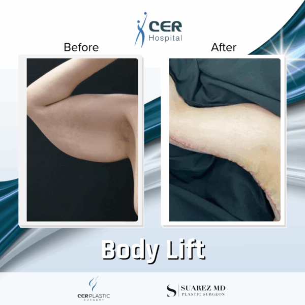 Mini Body Lift - 12064