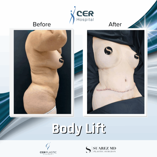 Body Lift and Eyelid Surgery - 5064 - Image 5