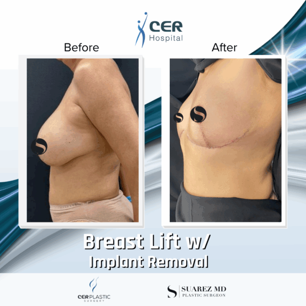 Breast Lift with Implant Removal - 5064 - Image 6