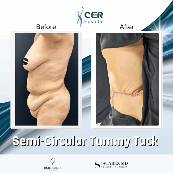 Semi Circular Tummy Tuck - 3064