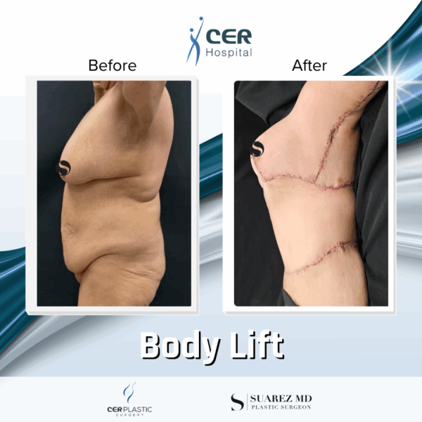 Body Lift - 20054 - Image 6