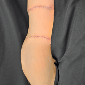 Body Lift – 20054