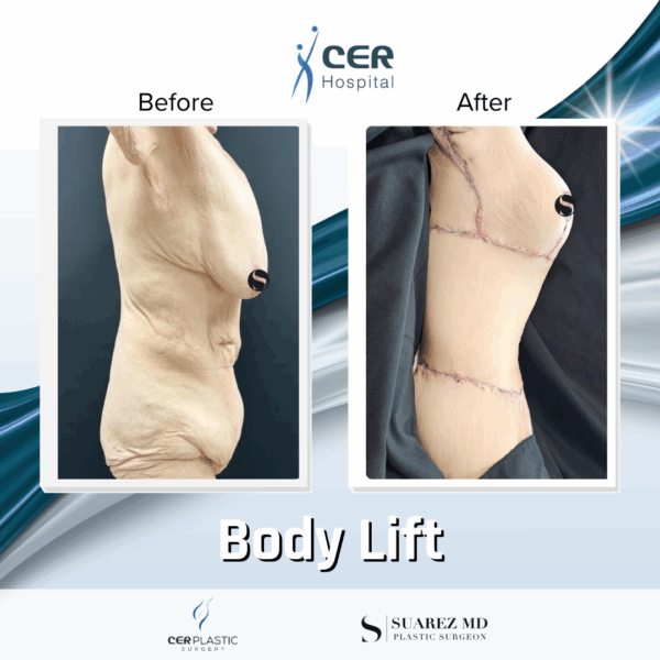 Body Lift - 17054 - Image 5