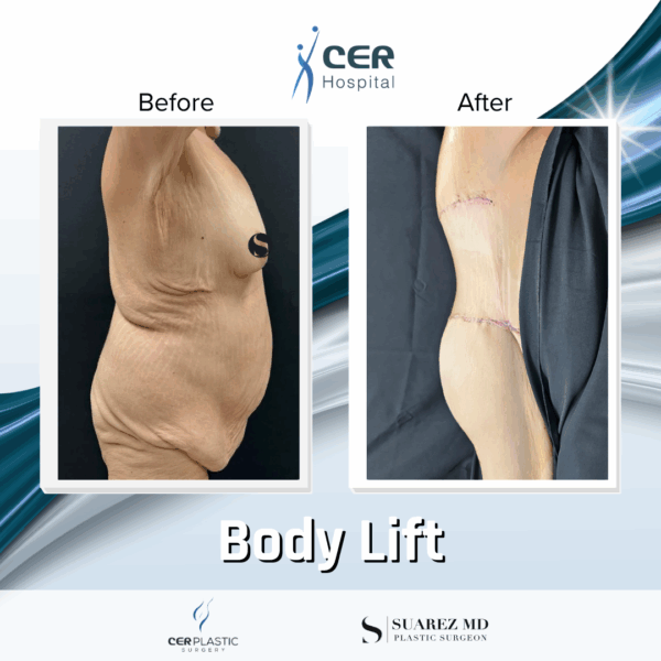 Body Lift - 8054 - Image 6