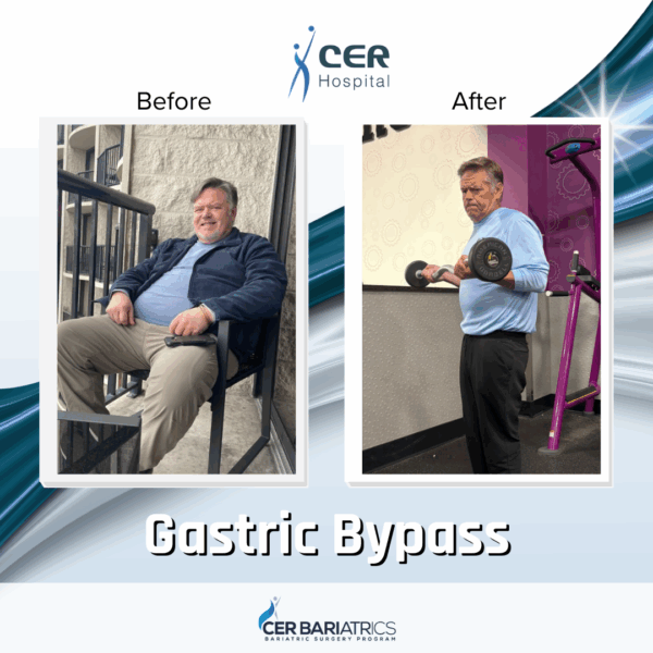 Gastric Bypass - Image 4