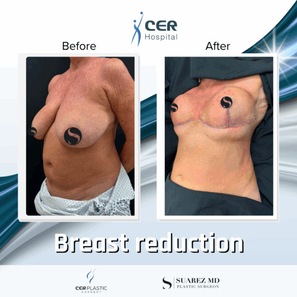 Breast Reduction - 042 - Image 6