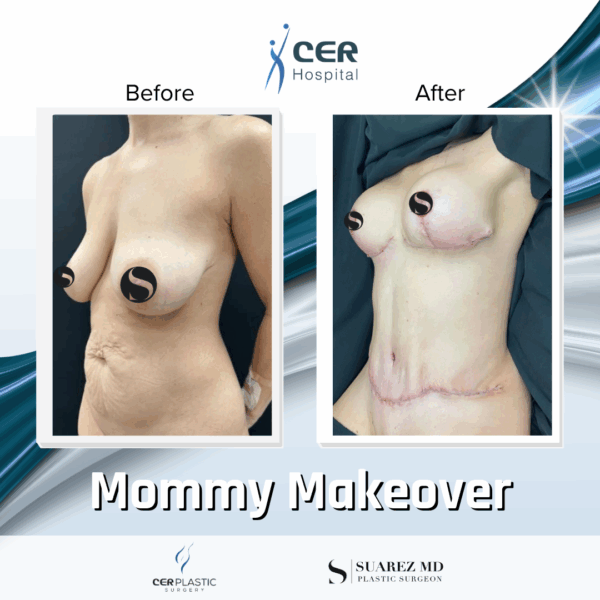 Mommy Makeover - 063 - Image 5