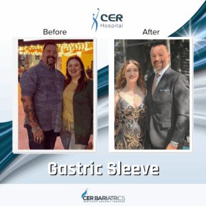 Gastric Sleeve