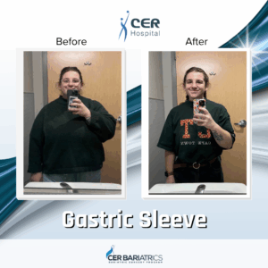 Gastric Sleeve