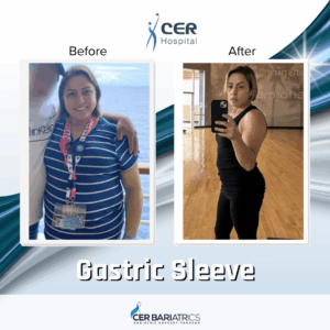 Gastric Sleeve