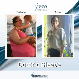 Gastric Sleeve