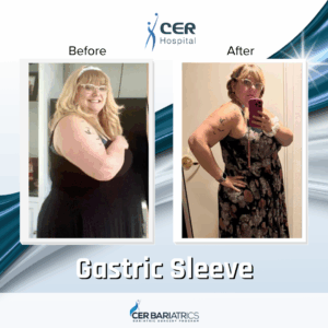 Gastric Sleeve