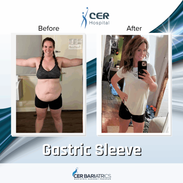 Gastric Sleeve