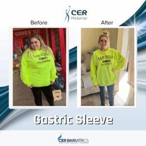 Gastric Sleeve