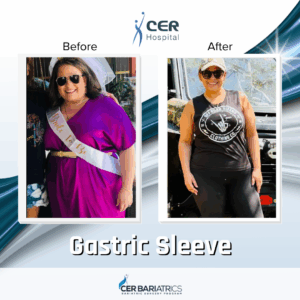 Gastric Sleeve