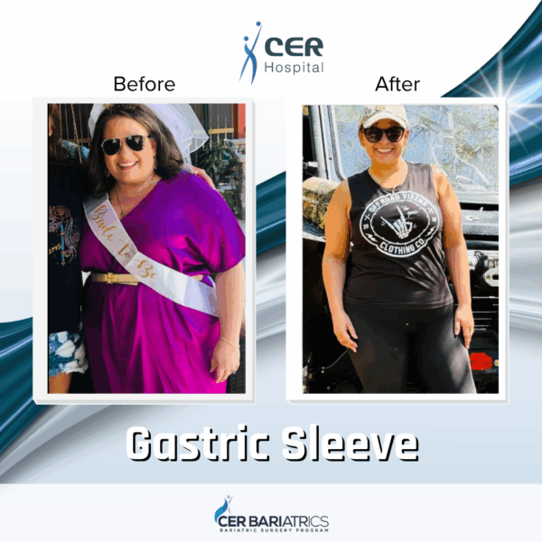 Gastric Sleeve - Image 2