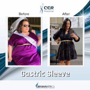 Gastric Sleeve