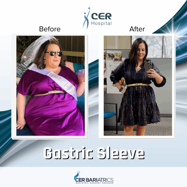 Gastric Sleeve