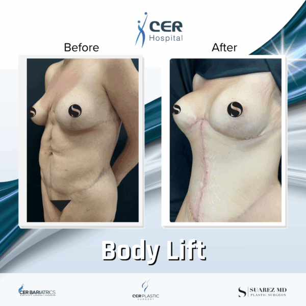 Body Lift - 243 - Image 6