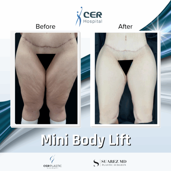 Body Lift - 094 - Image 6