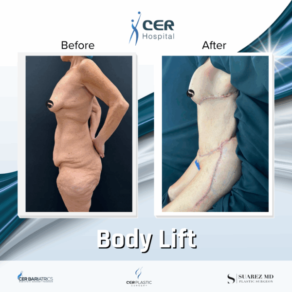 Body Lift - 291 - Image 7